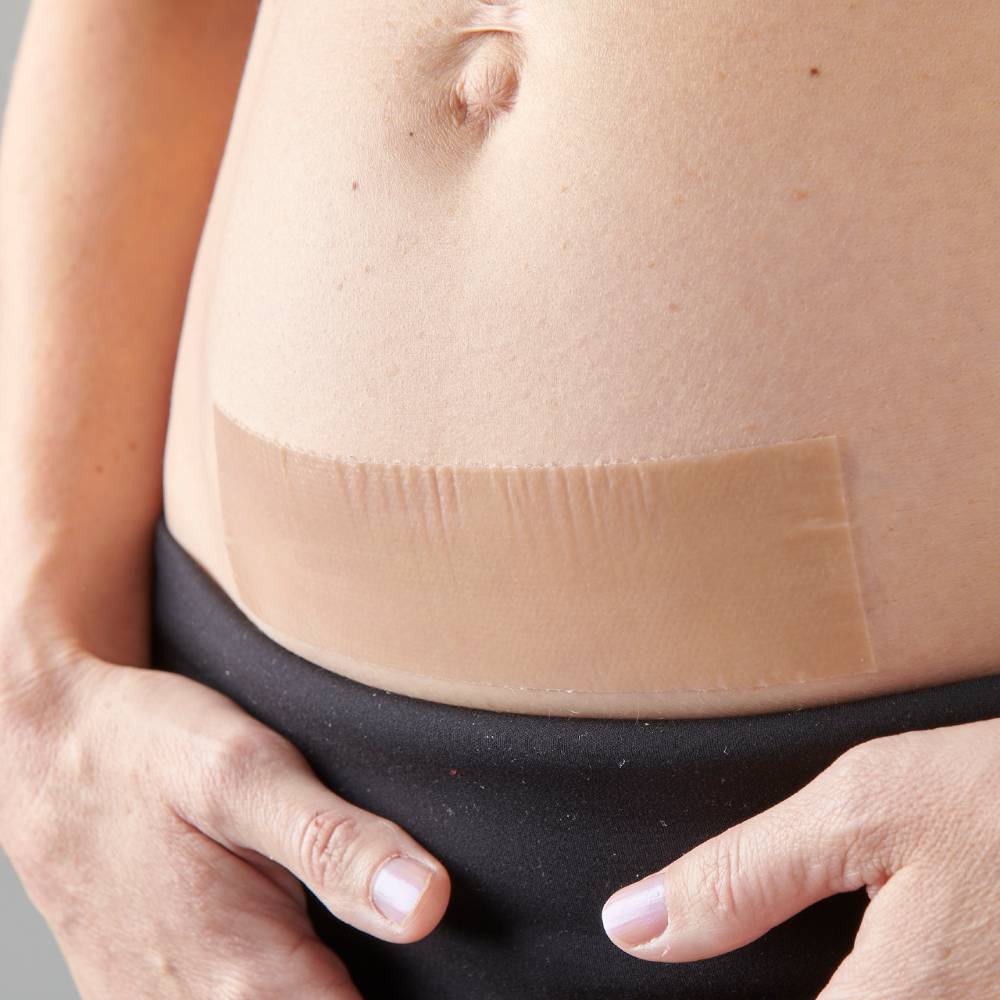 myscar Caesarean Silicon Strips "active" Scar Recovery PREORDER for 22nd February